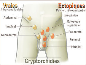 Cabinet d'Urologie - Cryptorchidie/ectopie testiculaire